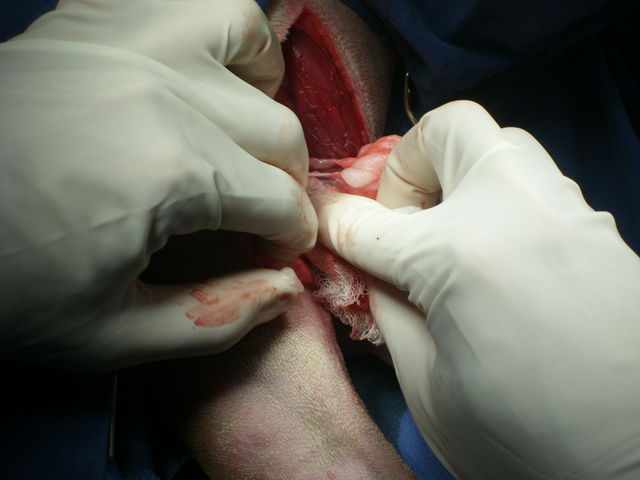 Extracción lipoma